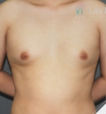 breast