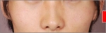 NJH Plastic Surgery,Reviews,Images, Promotions — Korea cost, reviews & before-after | MISOODA