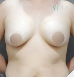 breast