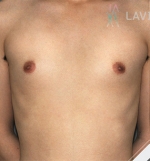 breast