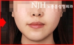 NJH Plastic Surgery,Reviews,Images, Promotions — Korea cost, reviews & before-after | MISOODA