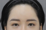 face lift
