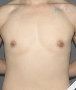 breast