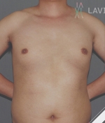 breast