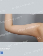 Liposuction