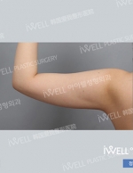 Liposuction