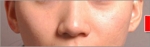 NJH Plastic Surgery,Reviews,Images, Promotions — Korea cost, reviews & before-after | MISOODA