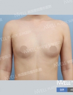 breast