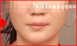 NJH Plastic Surgery,Reviews,Images, Promotions — Korea cost, reviews & before-after | MISOODA