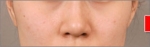 NJH Plastic Surgery,Reviews,Images, Promotions — Korea cost, reviews & before-after | MISOODA
