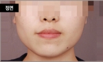 NJH Plastic Surgery,Reviews,Images, Promotions — Korea cost, reviews & before-after | MISOODA
