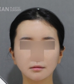 face lift