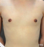 breast