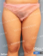 Liposuction