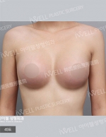 breast