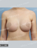 breast