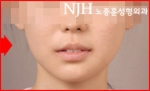 NJH Plastic Surgery,Reviews,Images, Promotions — Korea cost, reviews & before-after | MISOODA