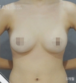 breast