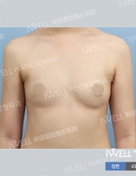 breast