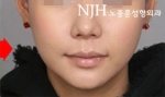 NJH Plastic Surgery,Reviews,Images, Promotions — Korea cost, reviews & before-after | MISOODA