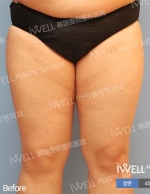 Liposuction