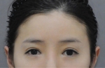face lift