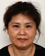 face lift