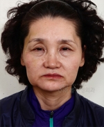 face lift