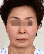 face lift