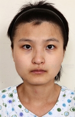 facial contouring