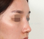 Rhinoplasty