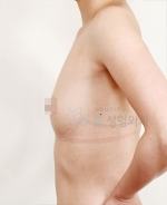 breast