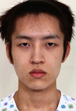 facial contouring
