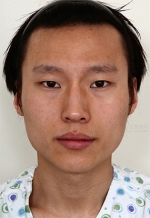 facial contouring