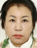 face lift