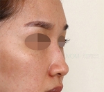 Rhinoplasty
