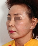 face lift