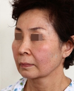 face lift