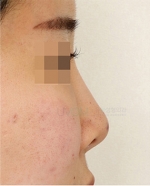 Rhinoplasty