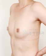 breast