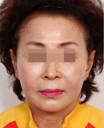 face lift