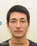 facial contouring