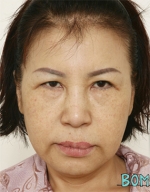 face lift