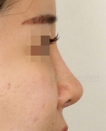 Rhinoplasty