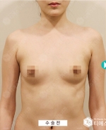 breast