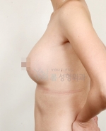 breast