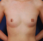 breast