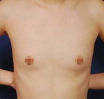 breast