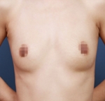 breast
