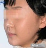 facial contouring